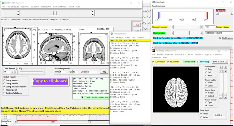 Figure 28 - Post-neurofeedback eyes-open z-score LORETA analysis for 30 Hz